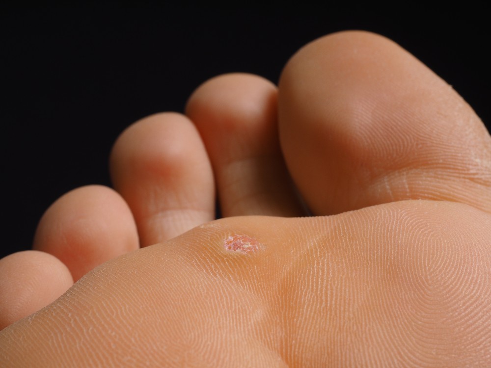 reducing calluses and corns